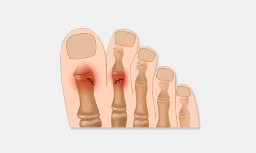 Реабилитация после перелома пальца ноги