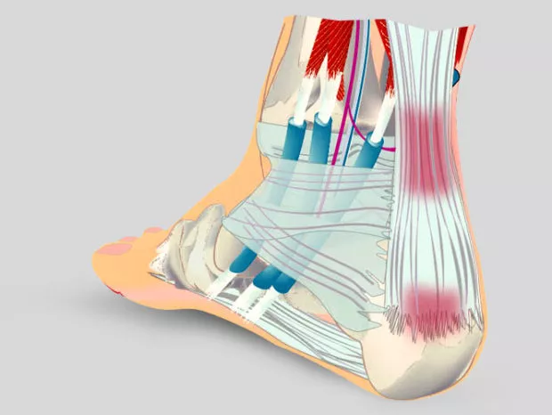 Изображение - Комплекс упражнений при тендините коленного сустава ahill-620x466