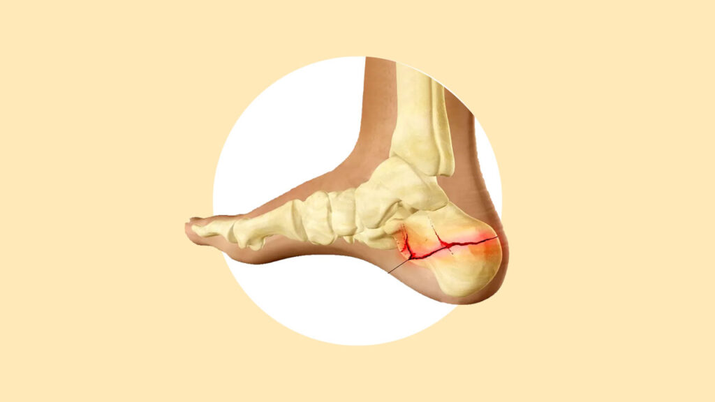 Перелом пяточной кости