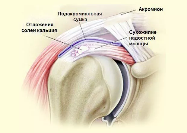 Упражнения при воспалении сухожилий