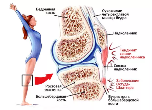 Изображение - Комплекс упражнений при тендините коленного сустава tendinit-koleno-620x450