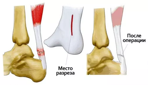 разрыв ахиллова сухожилия когда можно наступать на ногу после операции