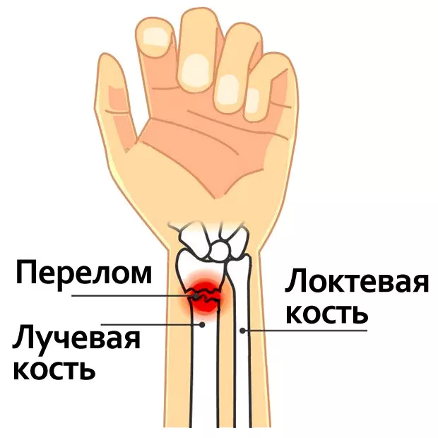 Переломы костей рук реабилитация