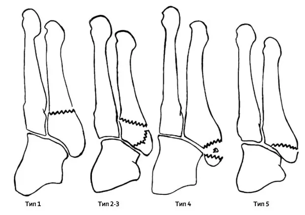 Восстановление после перелома пятой плюсневой кости стопы
