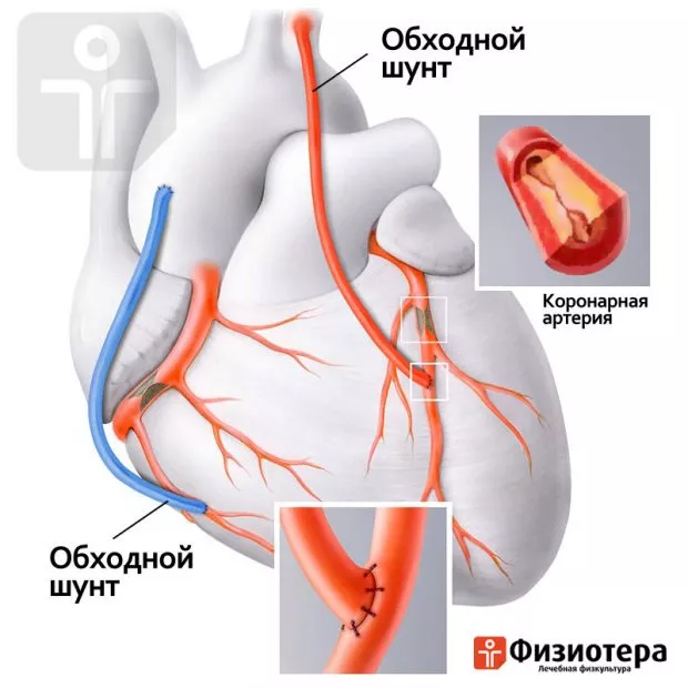 Коронарное шунтирование сосудов сердца реабилитация