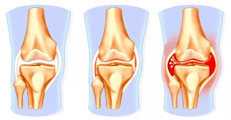 Изображение - Лфк при разрыве связок коленного сустава 3-stadii-gemartroza