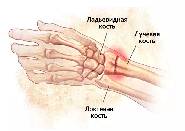 ЛФК при переломе запястья руки: рекомендации, примеры