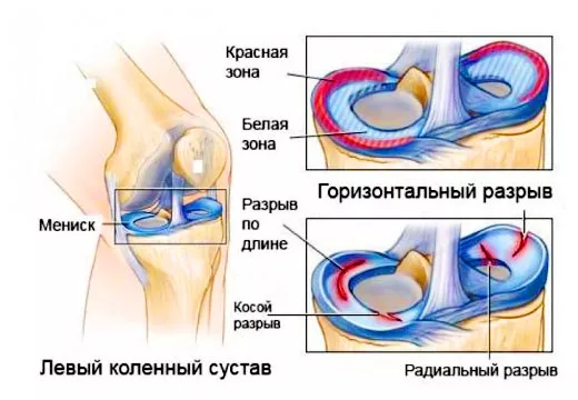 Изображение - Лфк при разрыве связок коленного сустава razriv-meniska