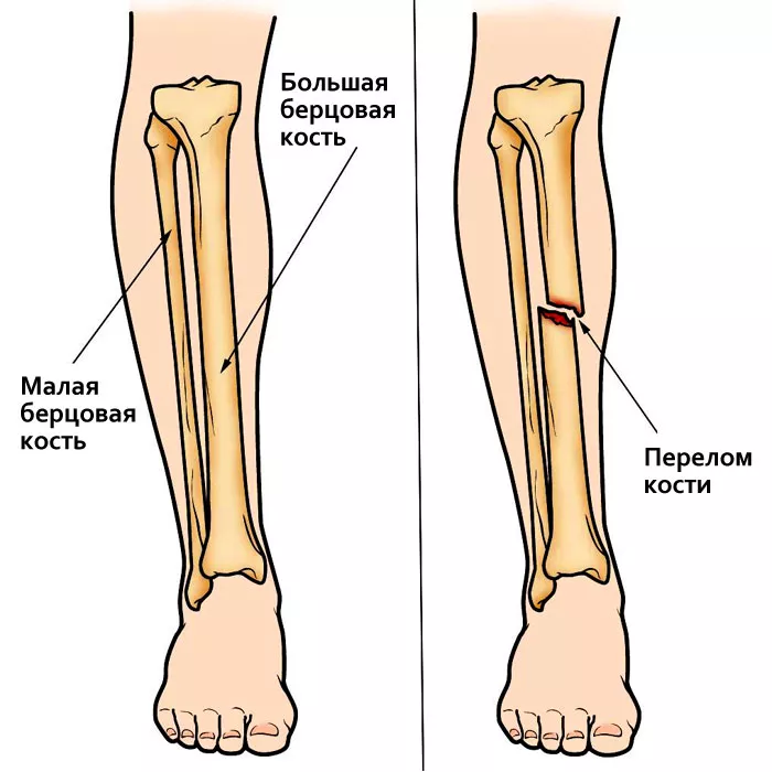 Как разработать ногу после перелома. Как разработать ногу после перелома берцовой кости