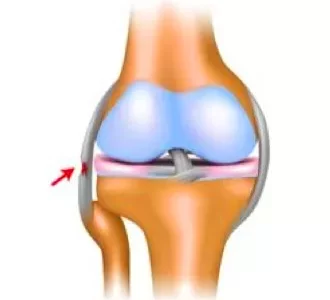 Лечение растяжения связок коленного сустава в домашних условиях