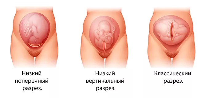 после кесарева сечения через сколько можно заниматься спортом и каким кормящей маме