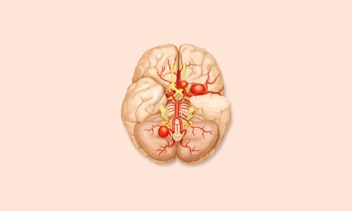 Аневризма головного мозга: причины, симптомы и лечение